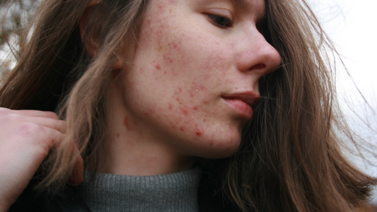 8 Natural Solutions for Reducing Acne Scars